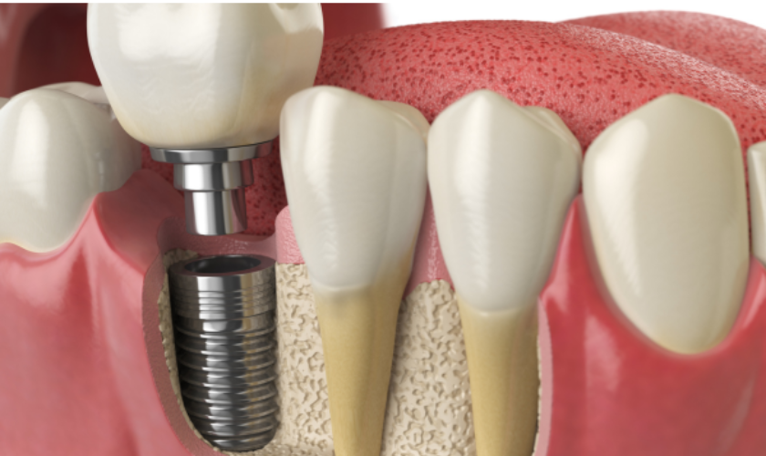 Dental implants in NYC restoring missing teeth and improving smile confidence at Sparkill Dental