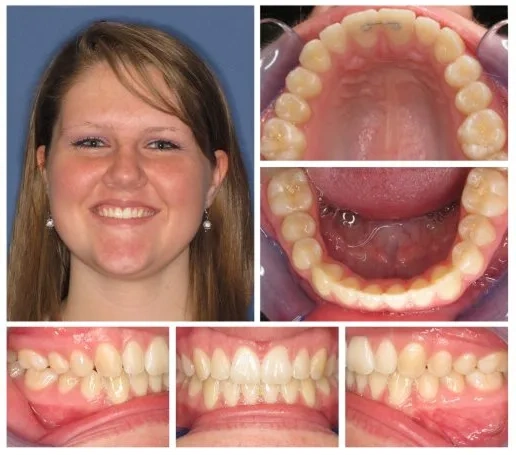 After Invisalign at Sparkill Dental