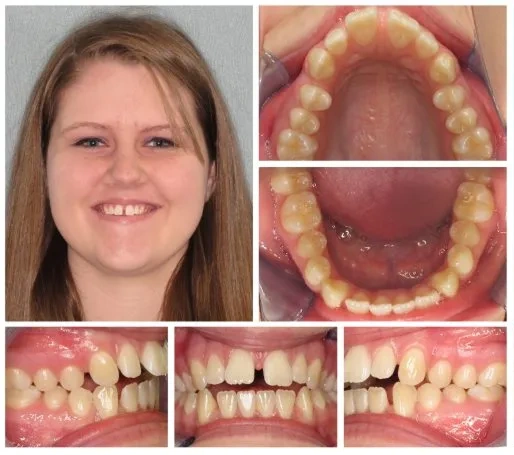 Before Invisalign treatment